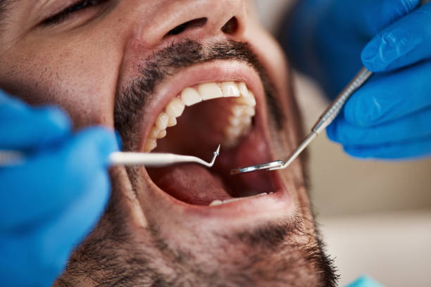 Best Emergency Wisdom Teeth Removal in Marshville, NC